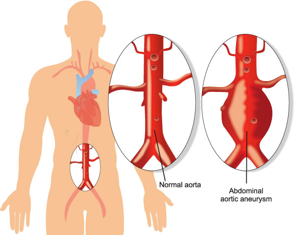 Vascular Care Specialists | Arterial Disease, Endovascular Surgery and Dialysis Access